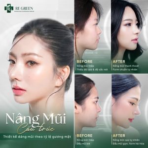 nâng mũi cấu trúc