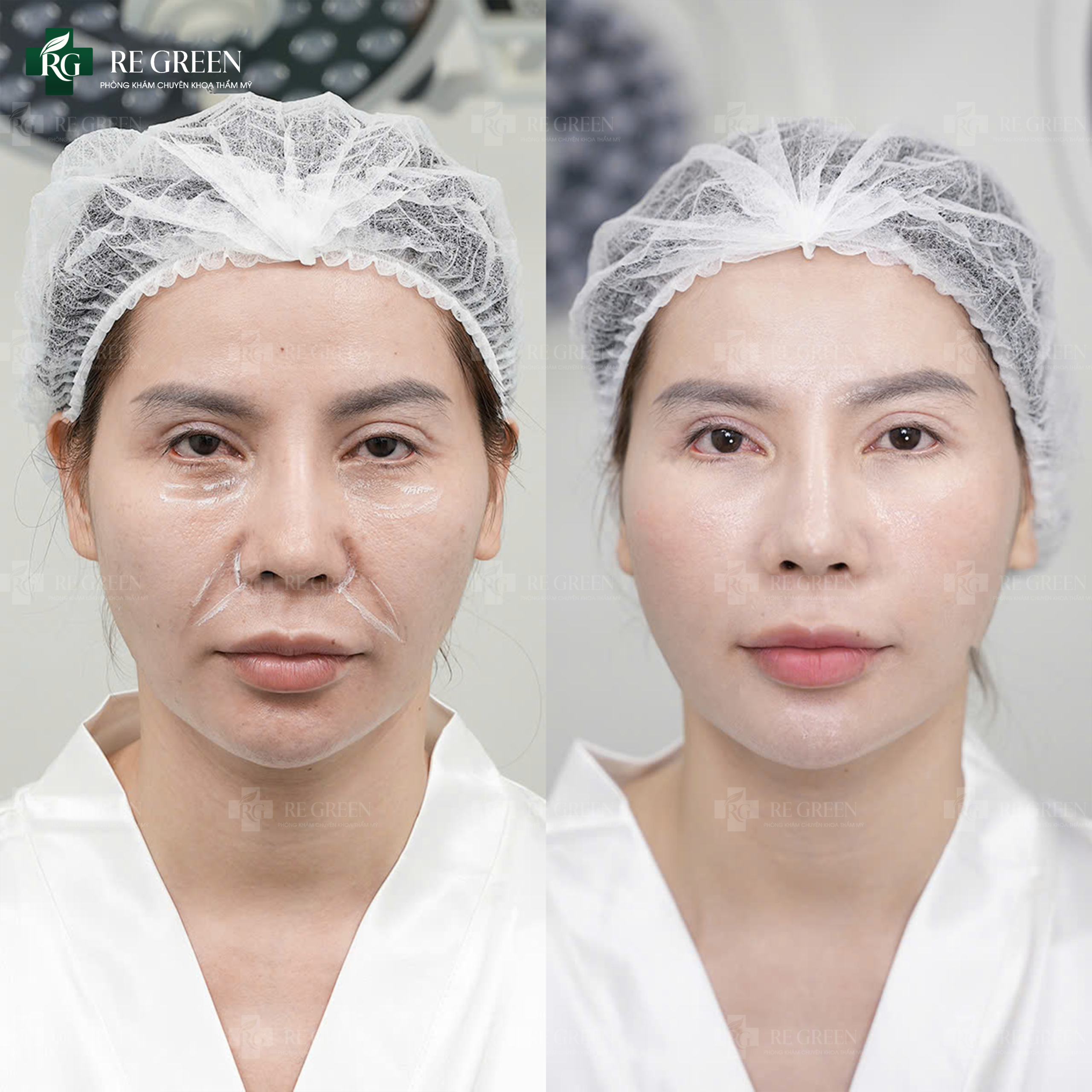 thermage FLX