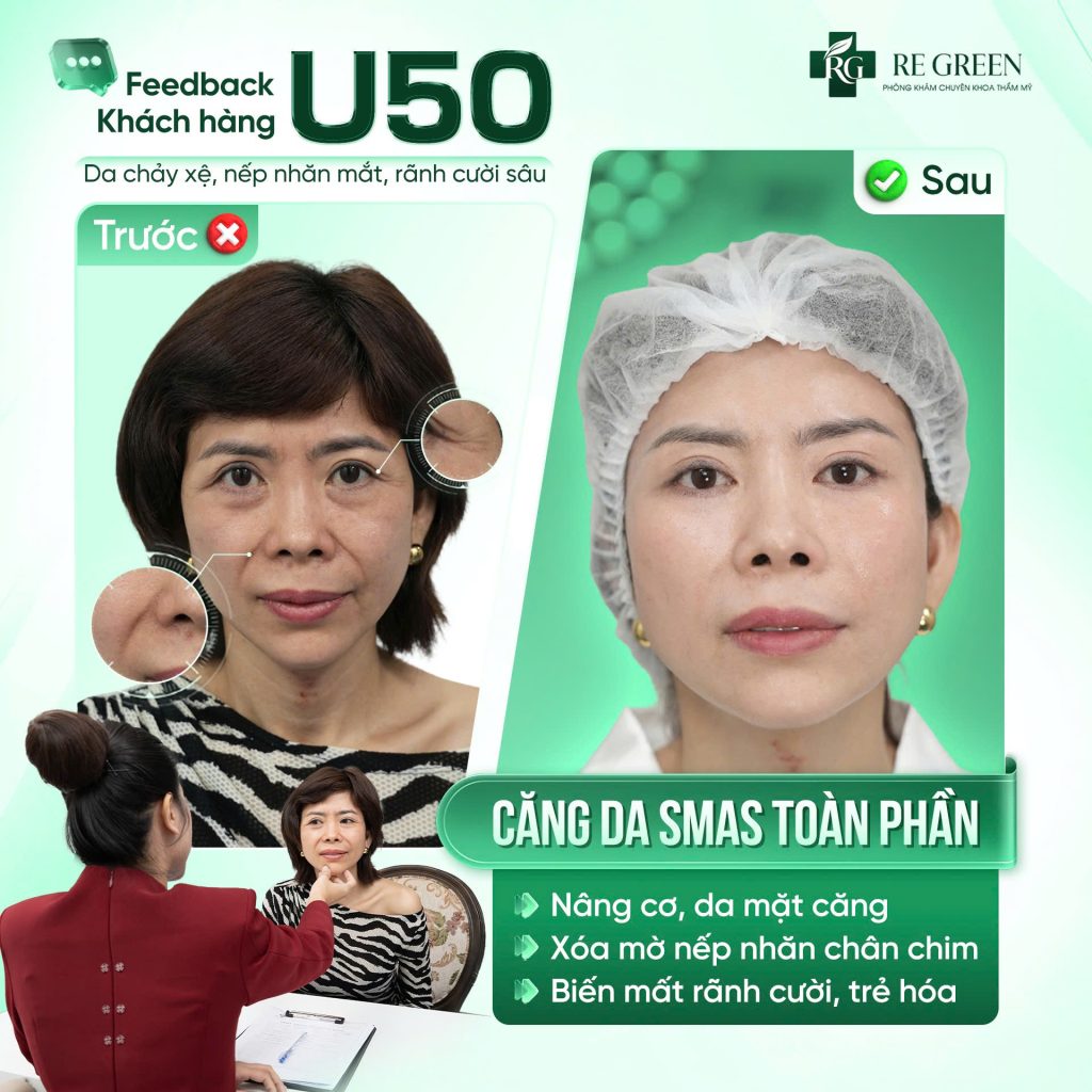 căng da smas