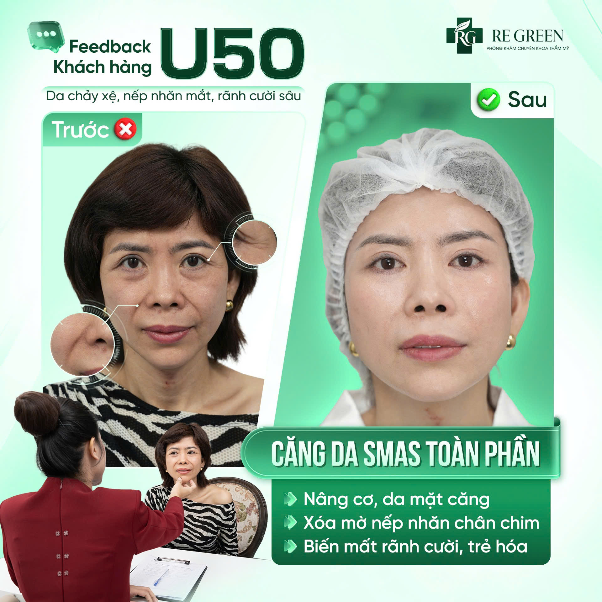 căng da smas