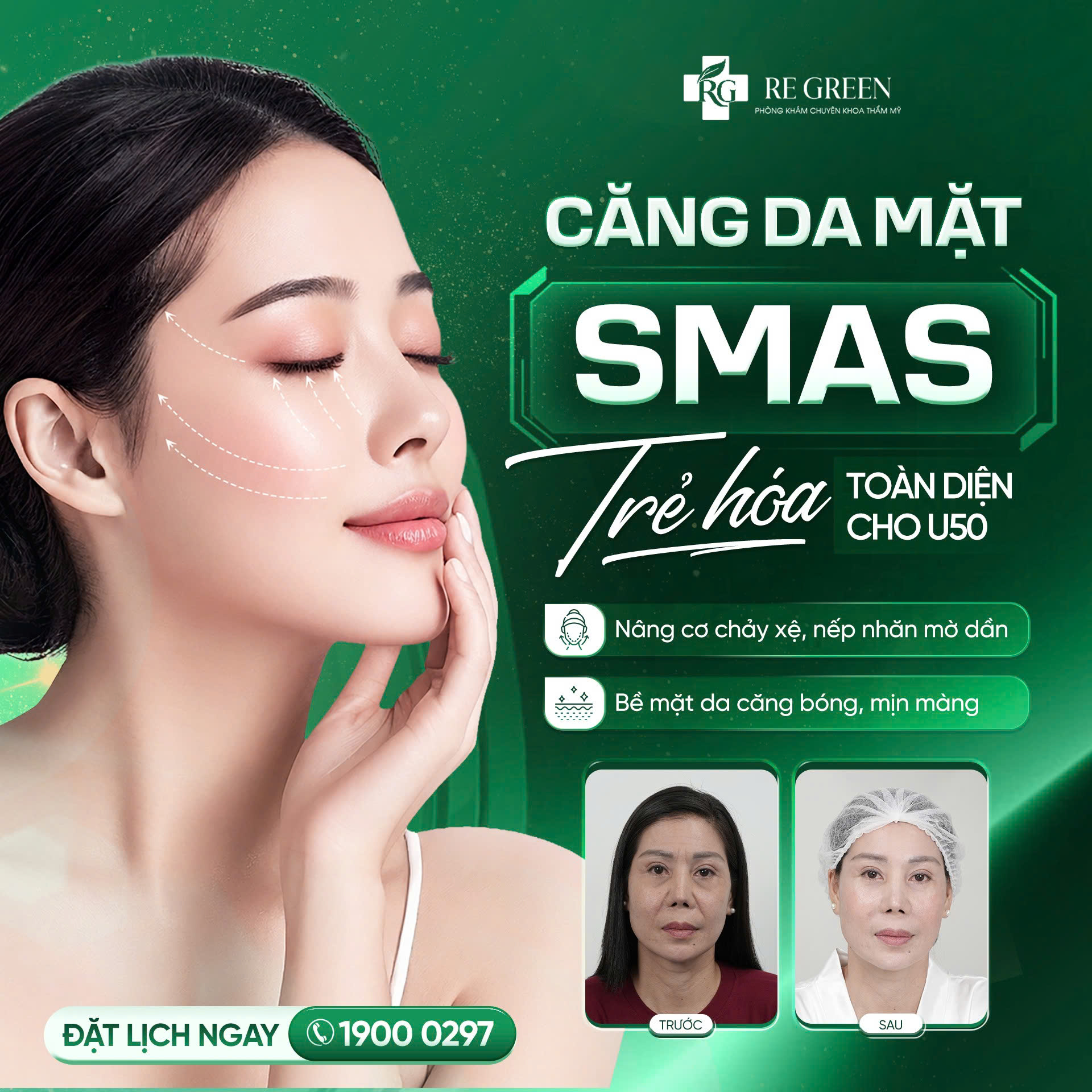 căng da SMAS