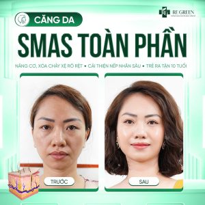 căng da SMAS