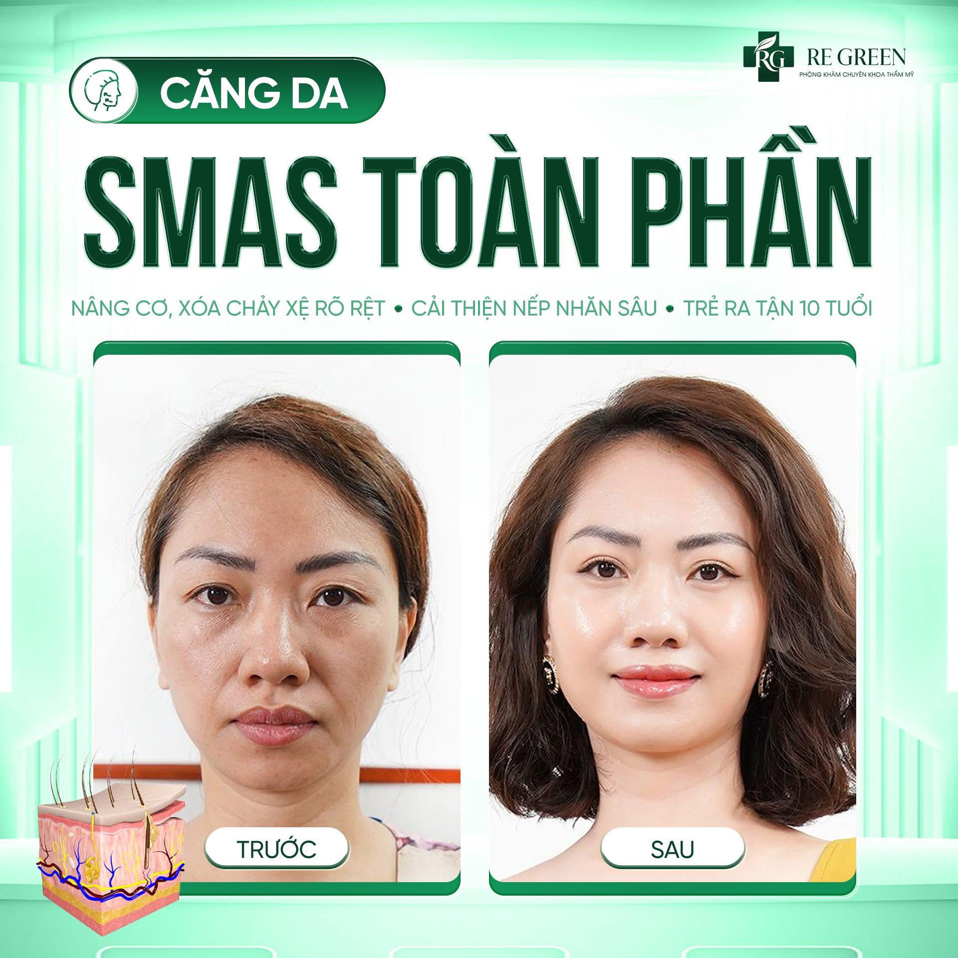 căng da SMAS