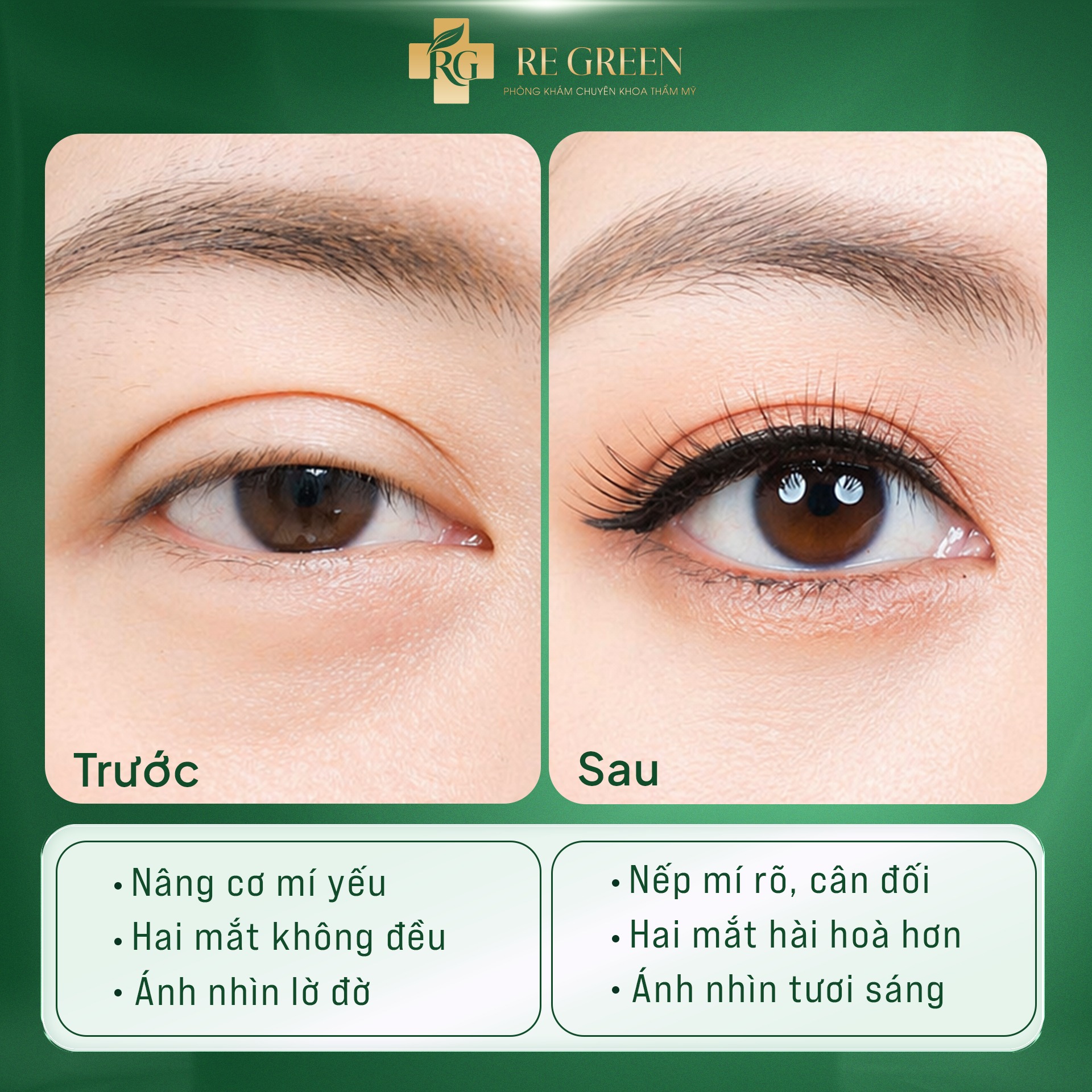 nhấn mí