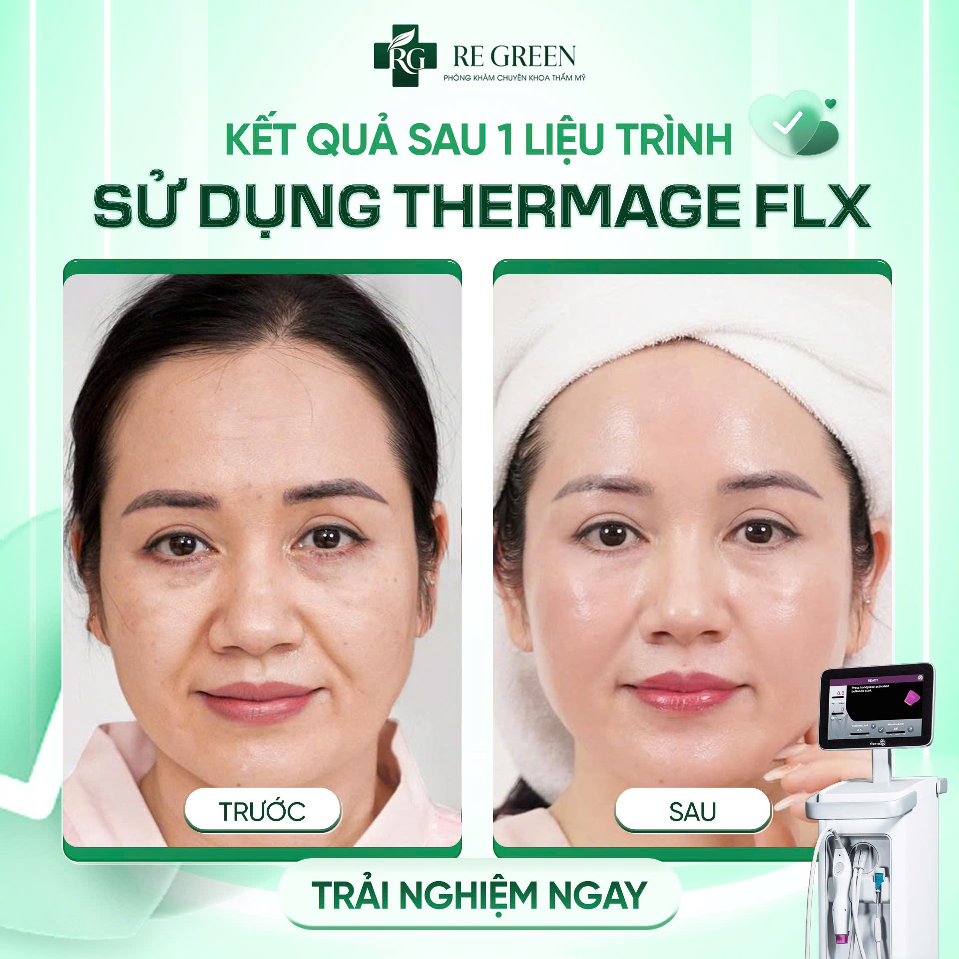 thermage FLX