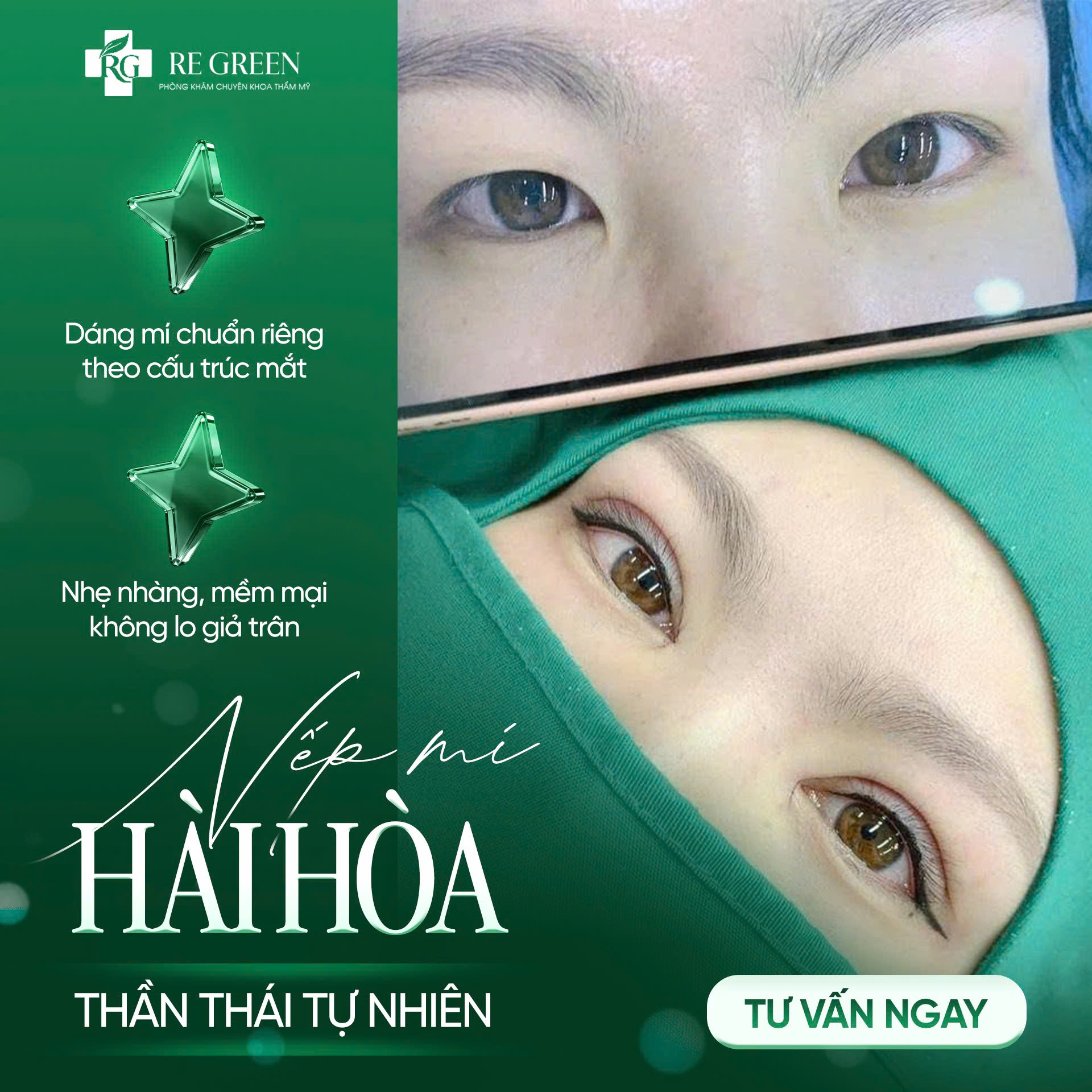 cắt mí