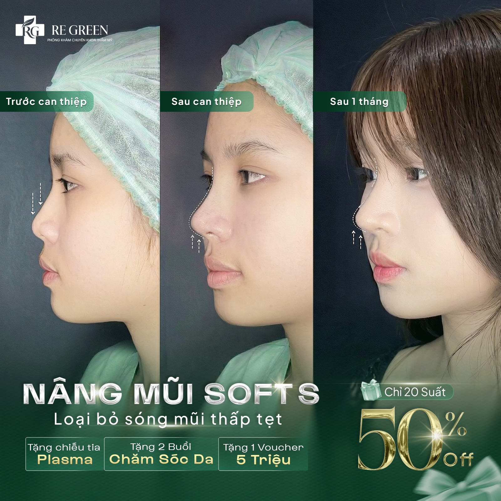 nâng mũi