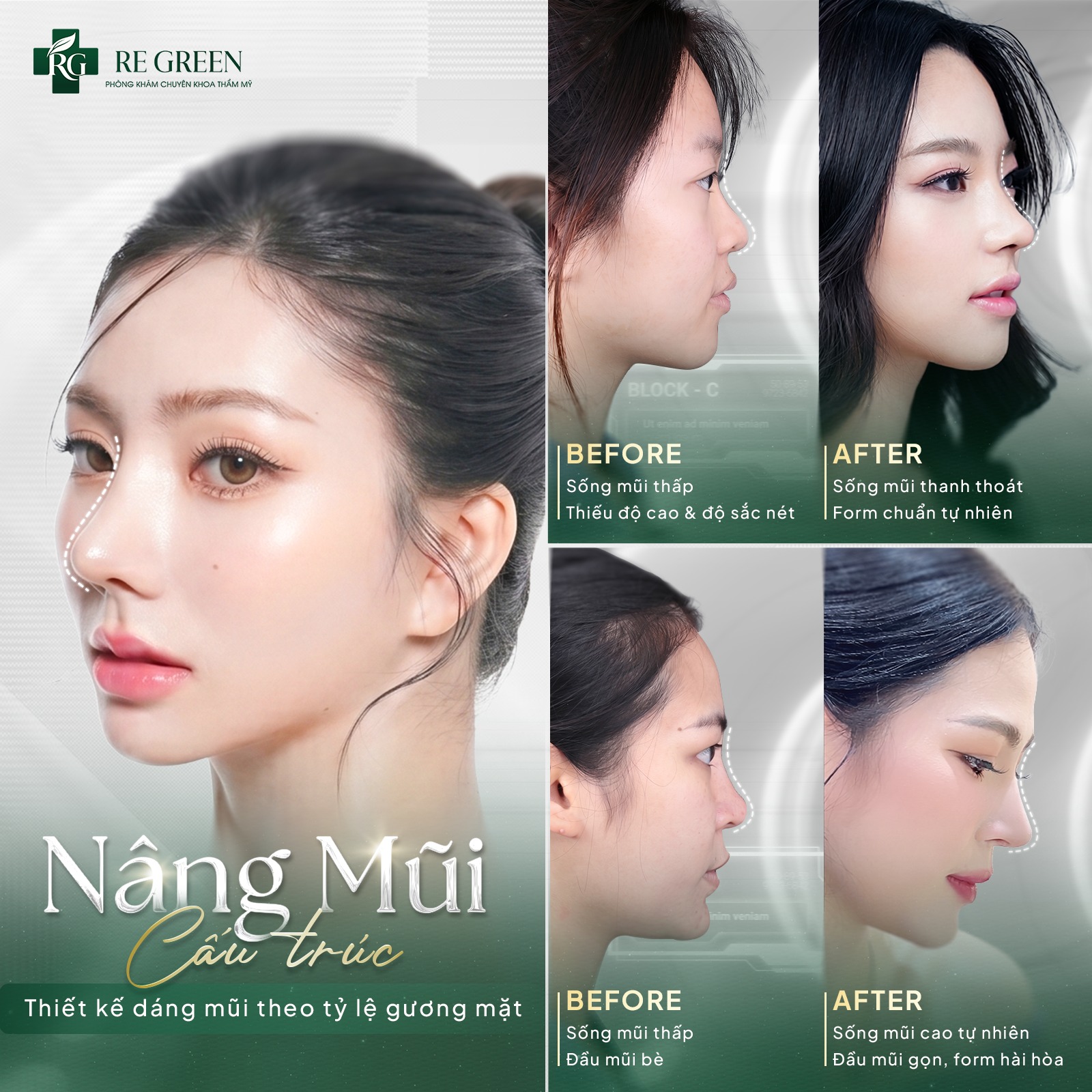 sửa mũi s-line