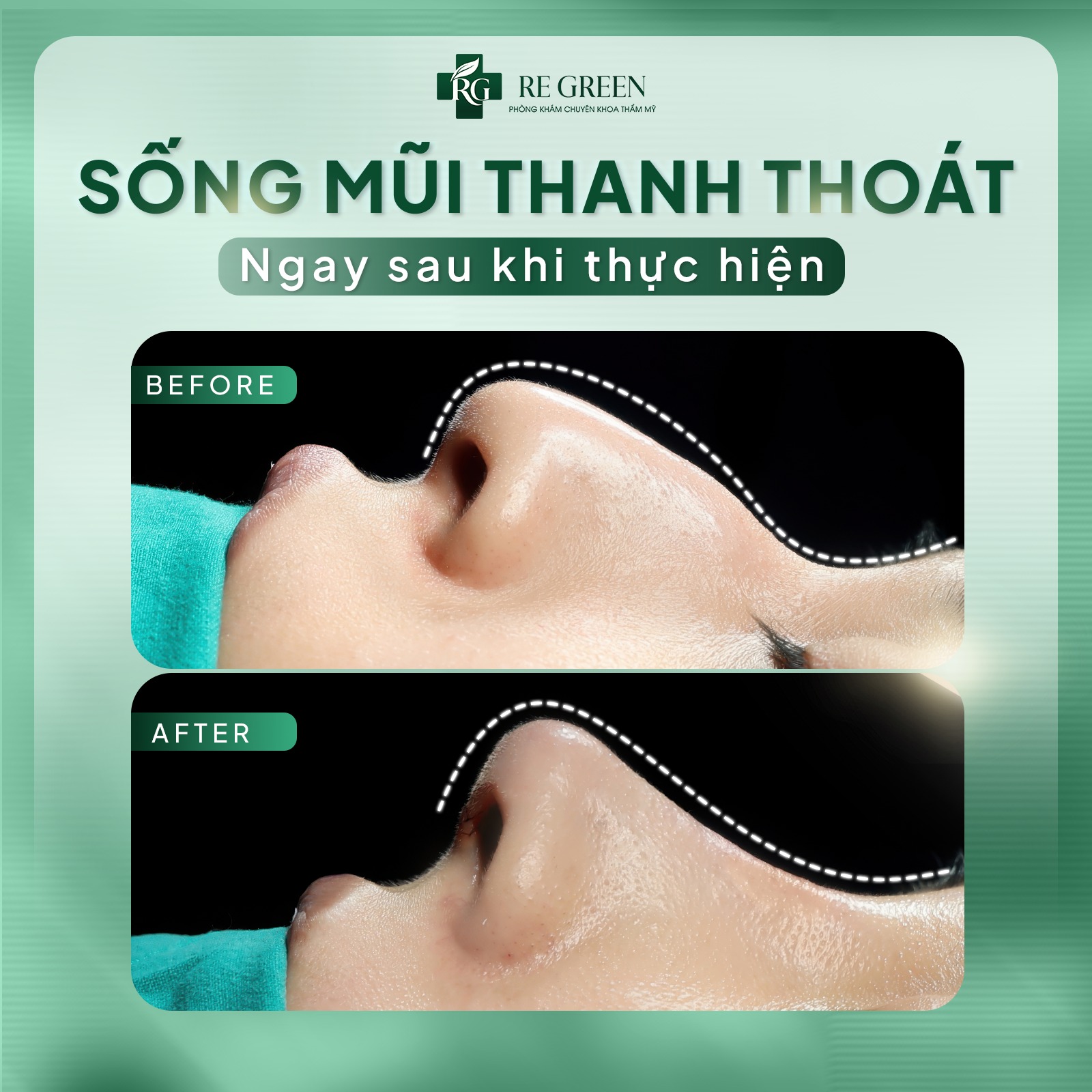 sửa mũi soft s