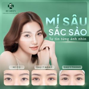 nhấn mí sắc sảo