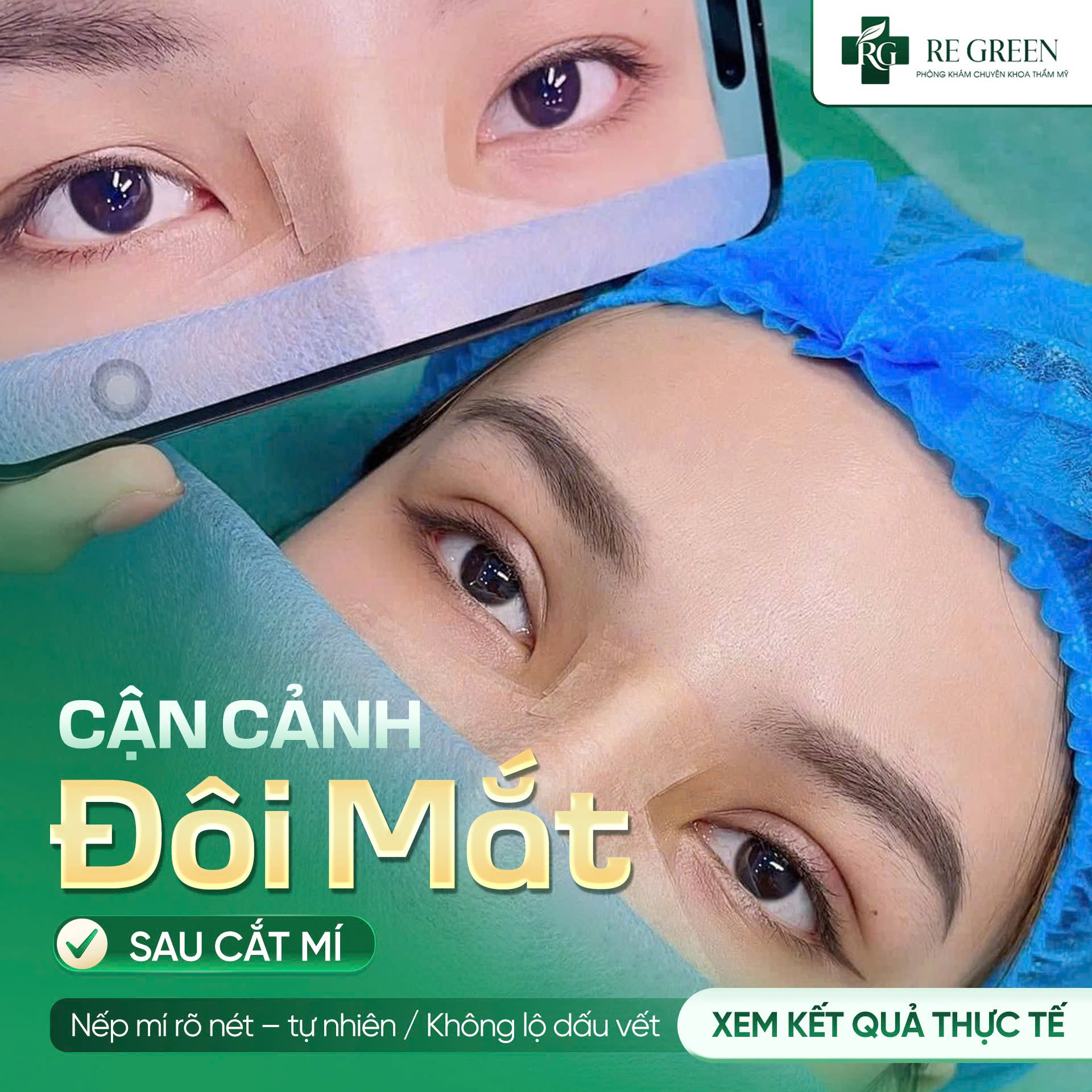 cắt mí
