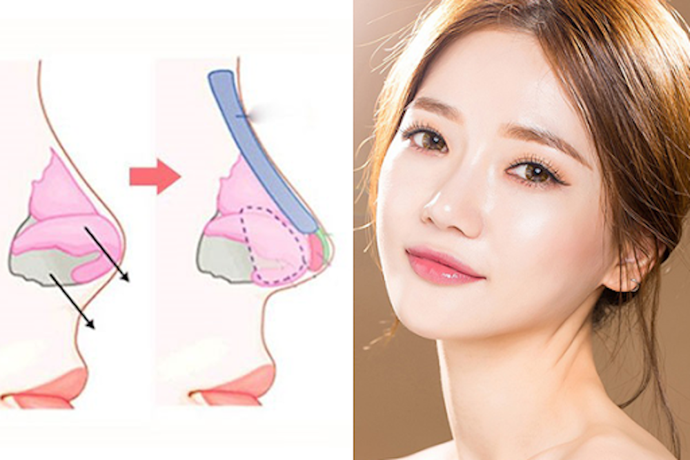 nâng mũi bọc sụn