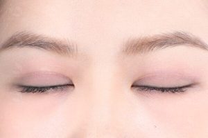 sẹo trắng sau cắt mí