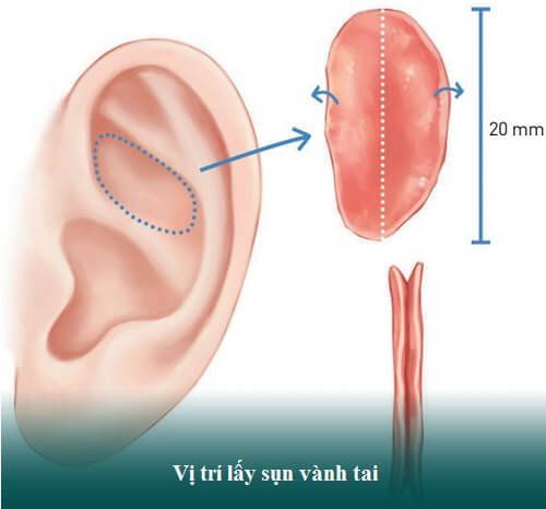 nâng mũi bằng sụn